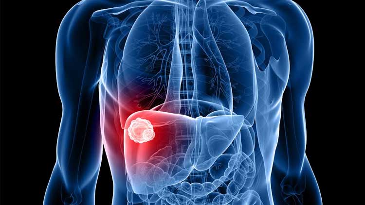 肝炎（かんえん）とは